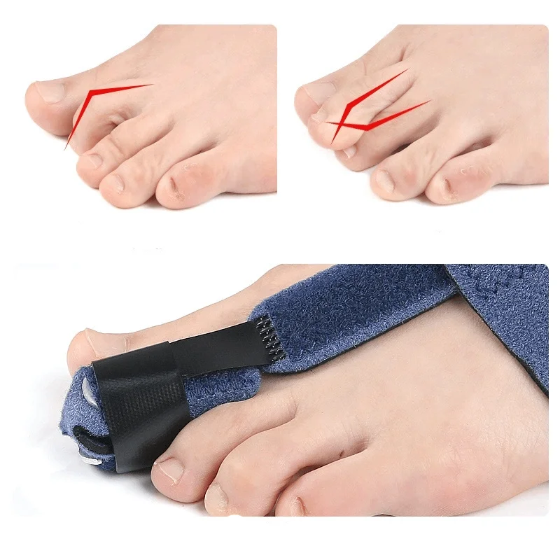 1/2Pcs Toe Corrector Toe Fracture Fixator Orthotics Foot Bone Thumb Adjuster Correction Soft Pedicure Socks Bunion Straightener 4