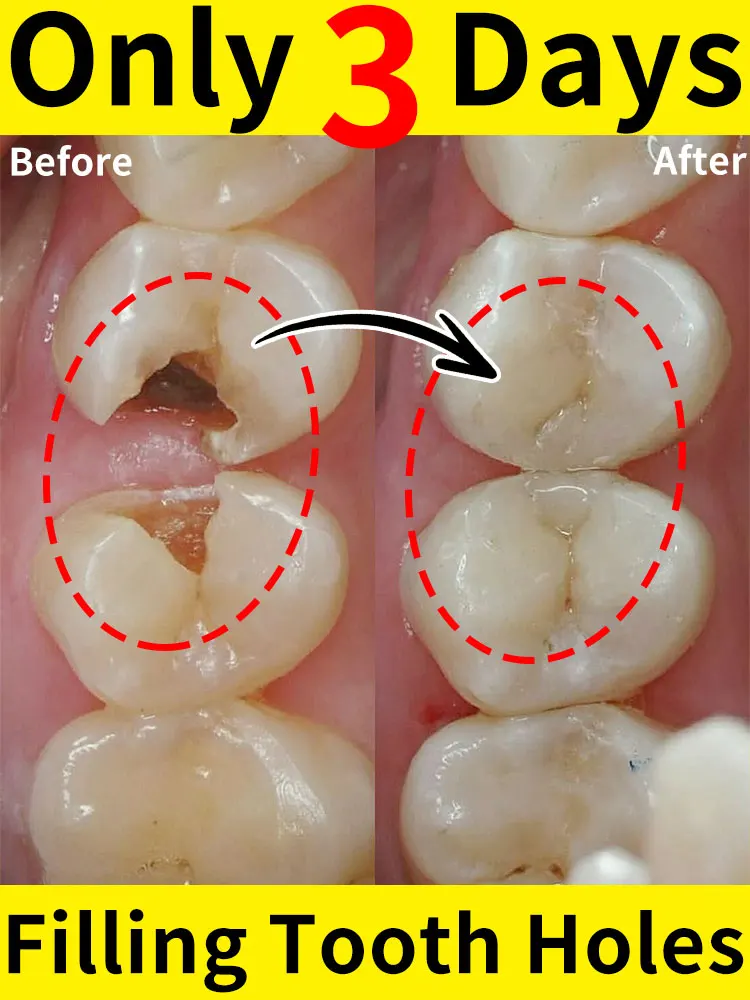 

Tooth decay Repair Repairing Cavities Anti Protecting Caries