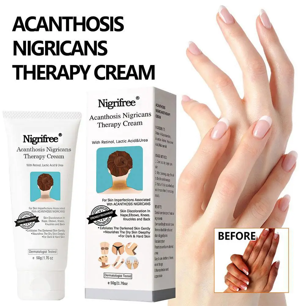 Acanthosis Nigricans Therapie Creme White ning Körper creme Entfernung von Hyper pigmentierung für dunkle Körperteile Pflege wie Hals, ein p9g9