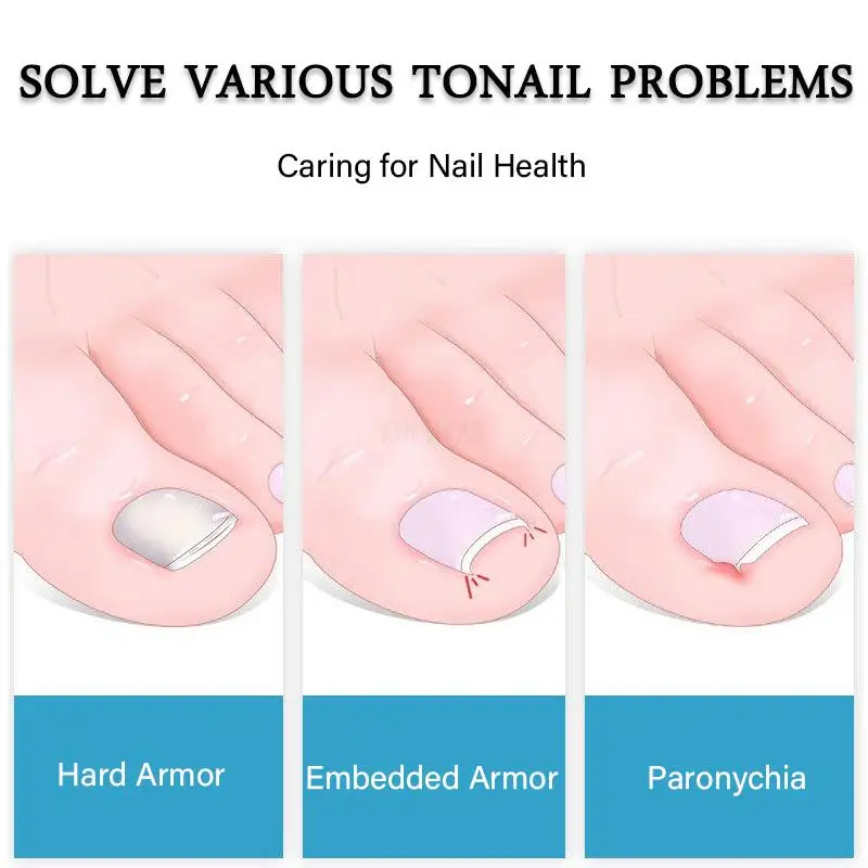 자란 손톱깎이 발톱깎이 네일 큐티클 클리퍼 전문 페디큐어 도구 Olecranon Clippers Paronychia 개선