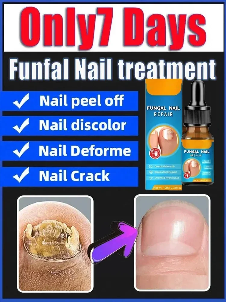 

Nail Fungus Treatment Liquid Feet Care Essence Nail Foot Repair Toe Nail Fungal Removal