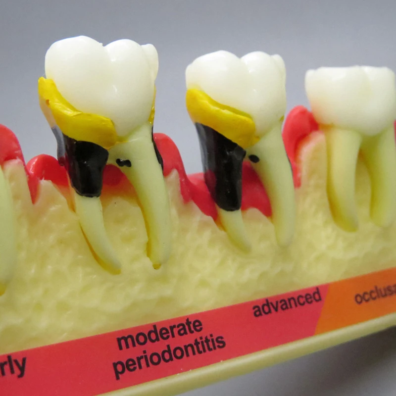 Model klasyfikacji chorób przyzębia dentystycznych Edukacja stomatologiczna Model zęba M4010 Model próchnicy zębów Klinika dentystyczna Zastosowanie