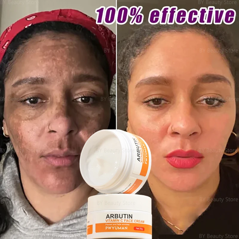 Vitamina c clareamento sardas creme remover manchas escuras melasma niacinamida clarear melanina anti-envelhecimento iluminar produtos de cuidados com a pele