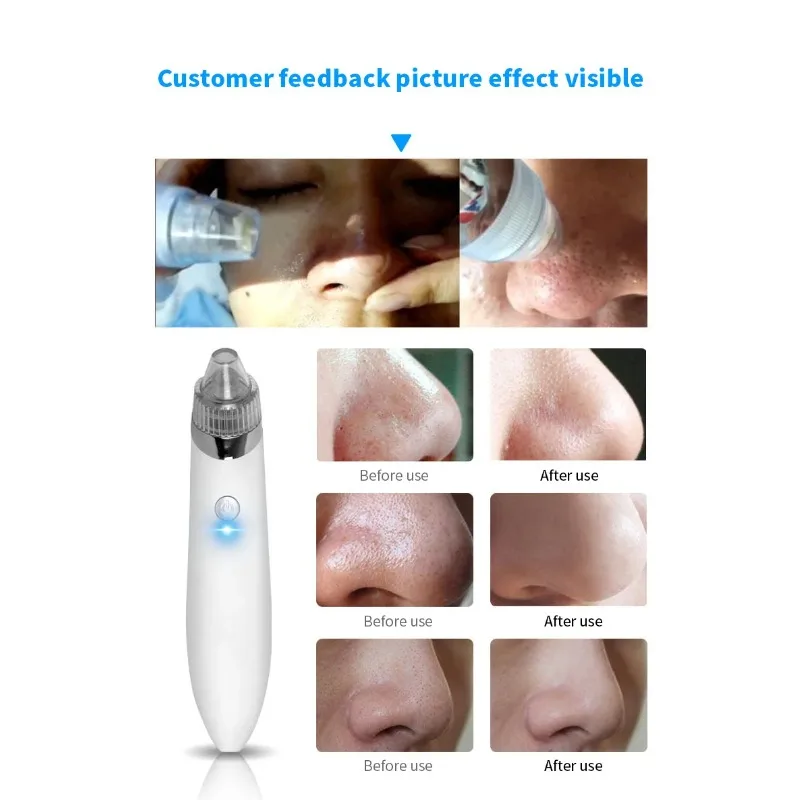 黒ずみ除去美容器 電動クレンザー 毛穴クリーナー 黒ずみ除去器