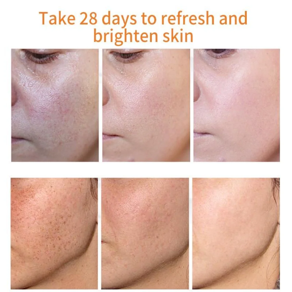 Effective Whiten Freckle Cream Remove Melasma Dark Spot  Anti-pigmentation Brighten Face Improve Dullness Cream Skin Care Cream