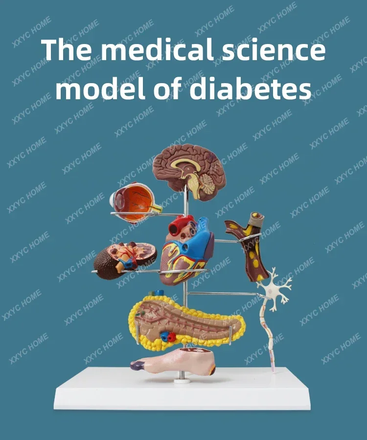 FORESTEDU Diabetes Model Teaching Anatomical Pathology Model 8 Parts Effects of Diabetes Details High Quality Pancreas Anatomy