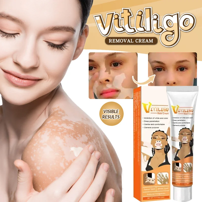 Vitiligo Cream Natural Relief Skin Treatment Soothing White Spot Removal Vitiligo Cream Eliminate Pigment White Spot  Removal