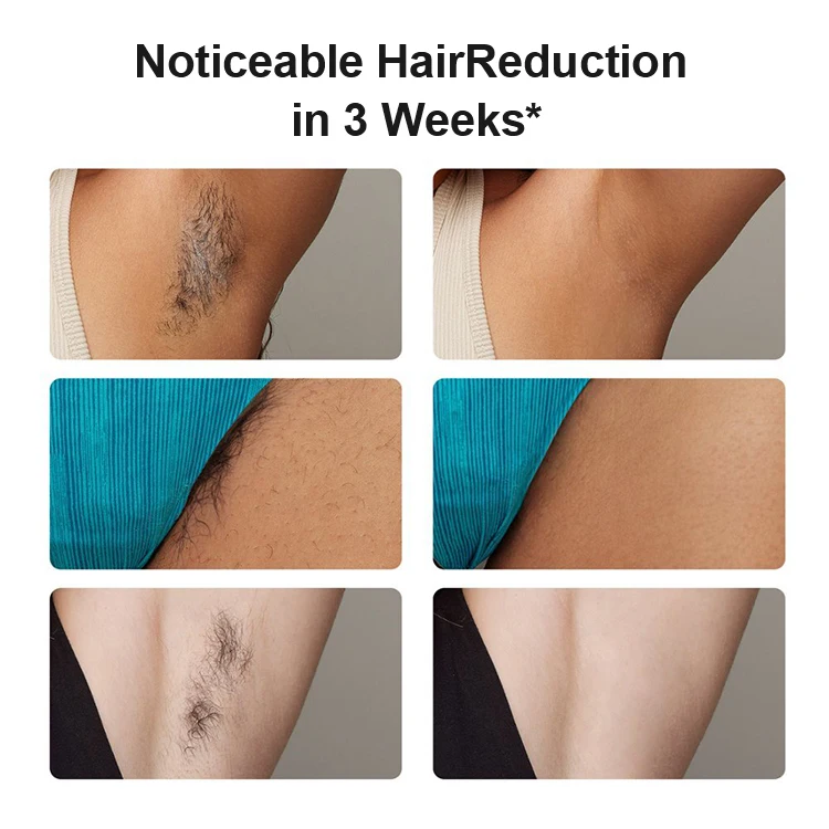 2X 24J تنظيف الشعر الدائم النساء إزالة الحلاقة الشعر الجسم نظيفة بيكيني خط الياقوت الجليد التبريد إزالة الشعر IPL الدائم