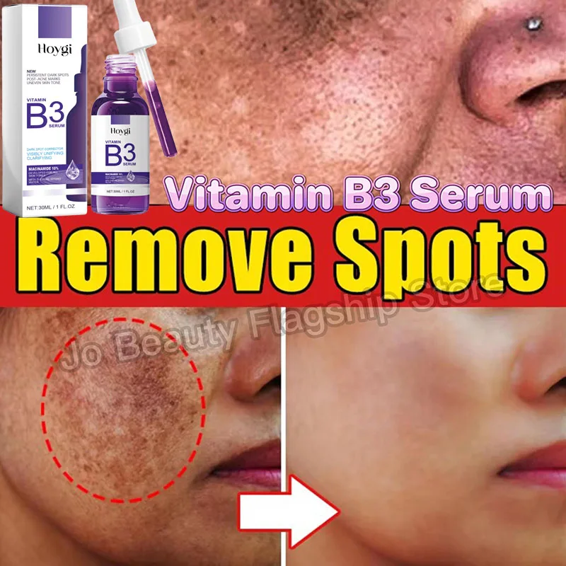 

Vitamin B3 Serum Fade Dark Spot Chloasma Lighten Melanin Pigmentation Smooth Pores Rejuvenation Brightening Moisturizing Essence