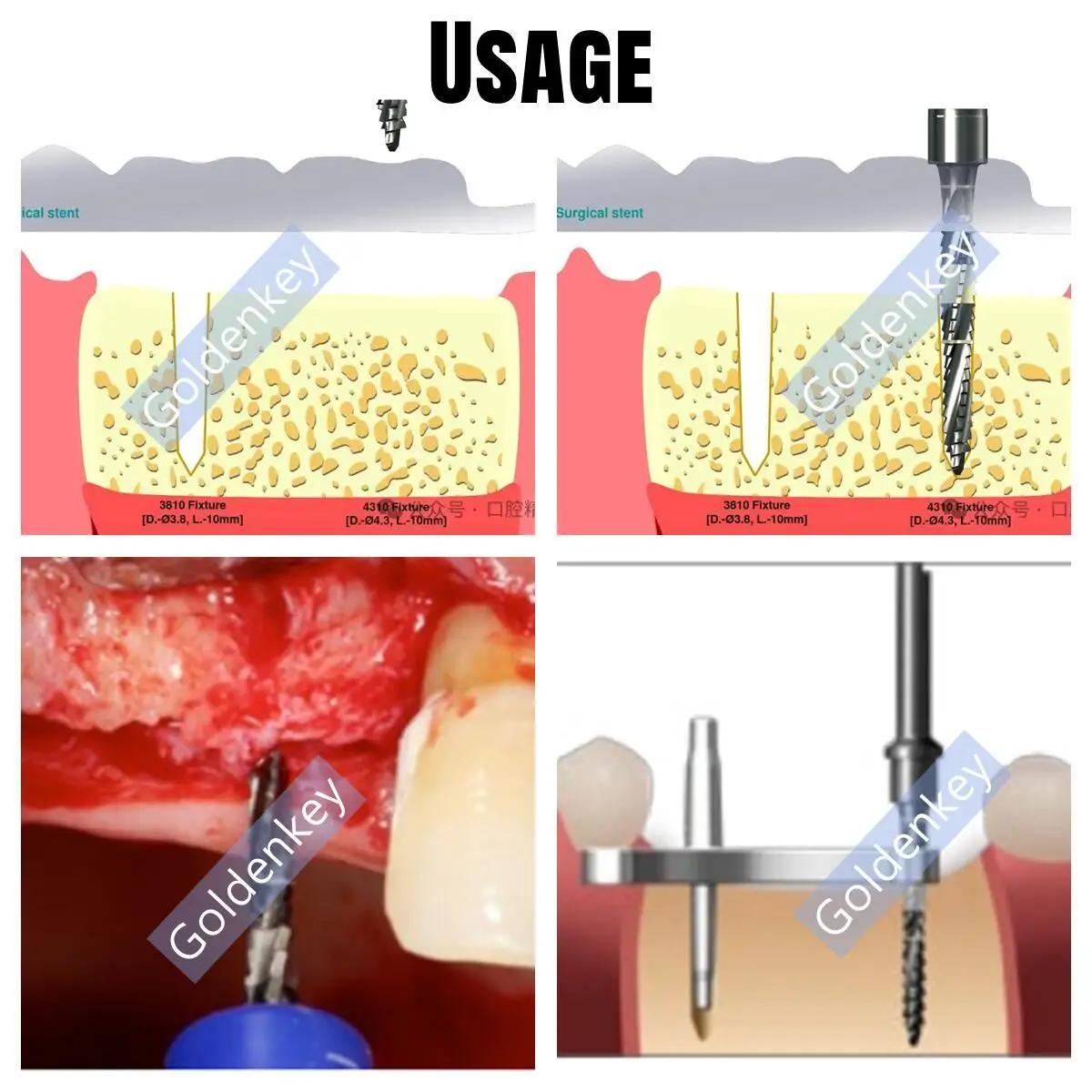 3Sizes Dental Guide Drill Cross Cutter Pilot Drill Lindemann Pioneer Bone Leval Cut Blade Fits Dentium