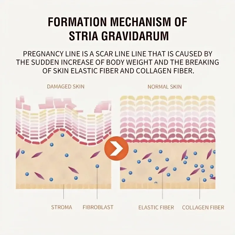 Crema de eliminación permanente de estrías, maternidad, mujeres embarazadas, embarazo, antiarrugas, reparación suave, reafirmante de la piel, cuidado de la piel corporal