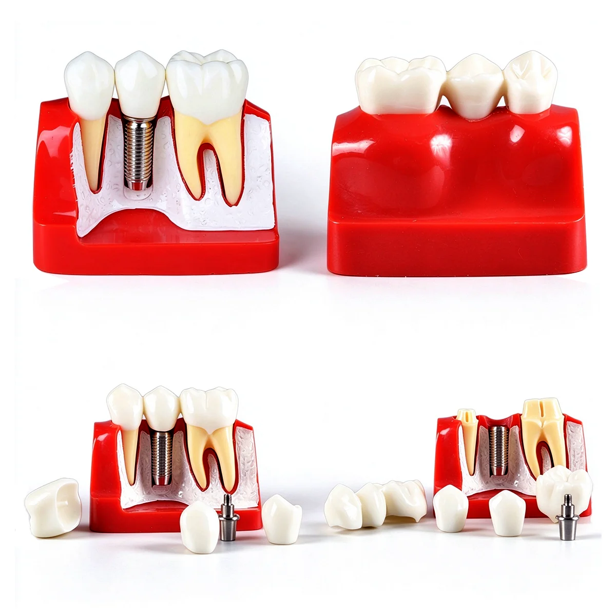 Dental 4 Times Implant Teeth Model Removable Analysis Crown Dentistry Demonstration Model Implants For Study Training Models