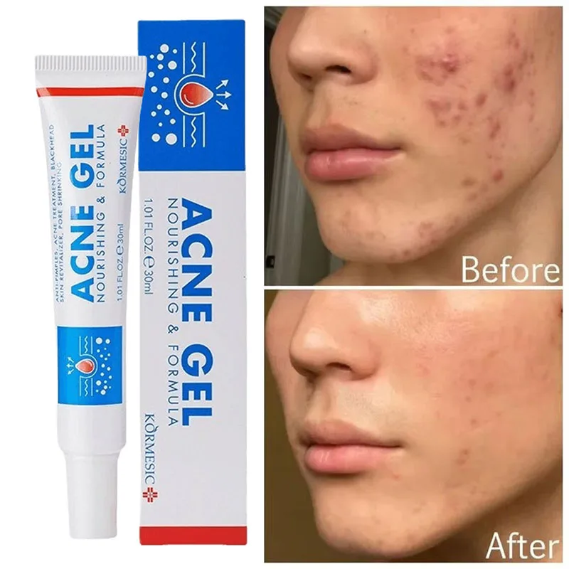 

Effective Acne Removal Cream Anti-Acne Repair Redness Pimple Spots Gel Deep Cleaning Pore Oil Control Moisturizing Skin Care 30g