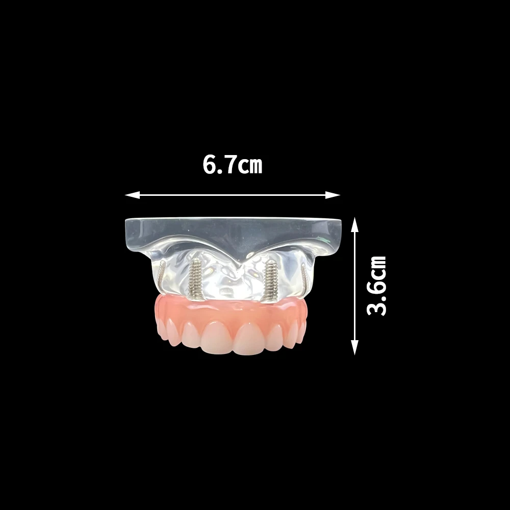 1 szt. Ząb górnopalczarny implantu dentystycznego 4 śruby z mostkiem słupkowym wymienny model odbudowy Typodont dla demonstracji dentystycznej