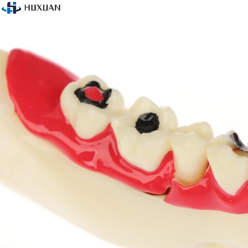 

1Pcs Dental Endodontic Treatment Model Anatomy Of Gums Mandible Tissue Anatomical Model Dentist Teach Study Demonstration