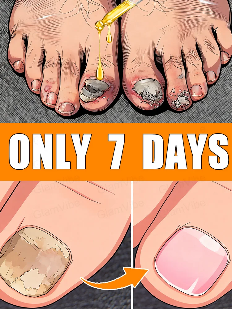 2025 يزيل الفطريات بسرعة واستعادة الأظافر الصحية #1