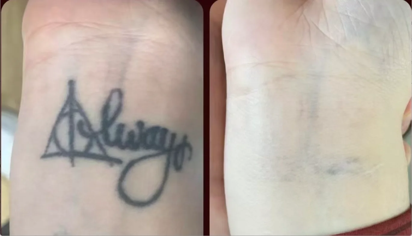 Mesin Penghilang Rambut Laser Nd Yag Dioda 808nm 2-In-1 Peralatan Salon Kecantikan Penjualan Terlaris Alat Penghilang Rambut Profesional