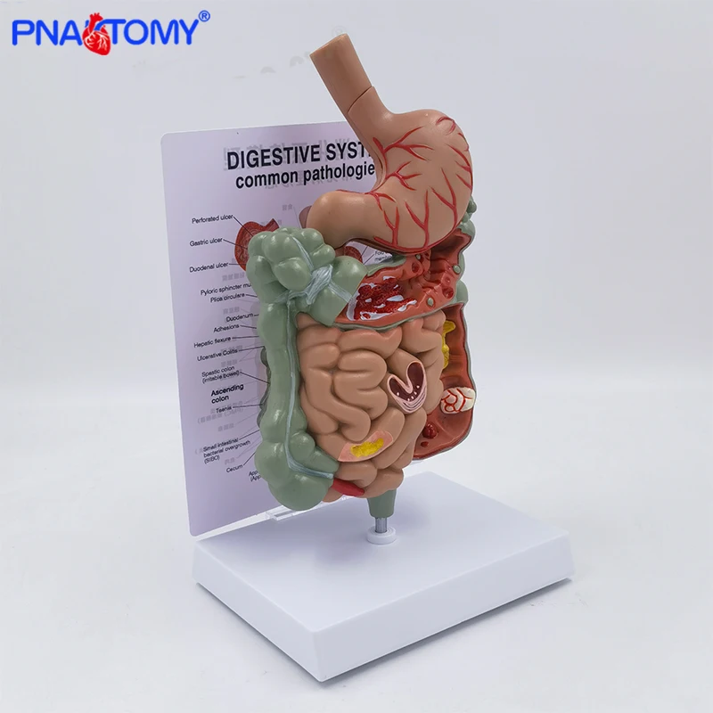 

GI TRACT Model Diseased Digestive System Stomach Anatomy Small and Large Intestine Colon Anatomical Model Educational Tool