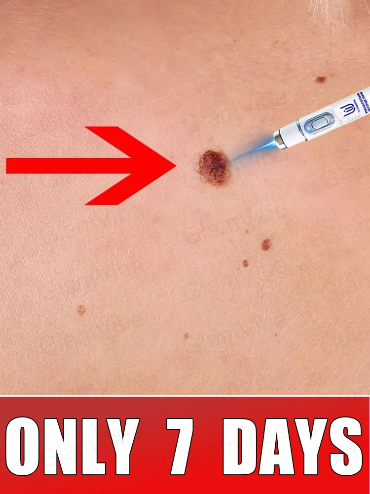 

blue light pen solve warts, hot sale wart care tools