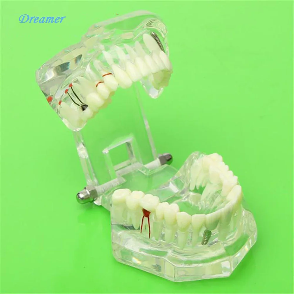 Dental Implant Disease Teeth Model with Restoration & Bridge Tooth Ideal for Treatment Planning Discussions with Patients