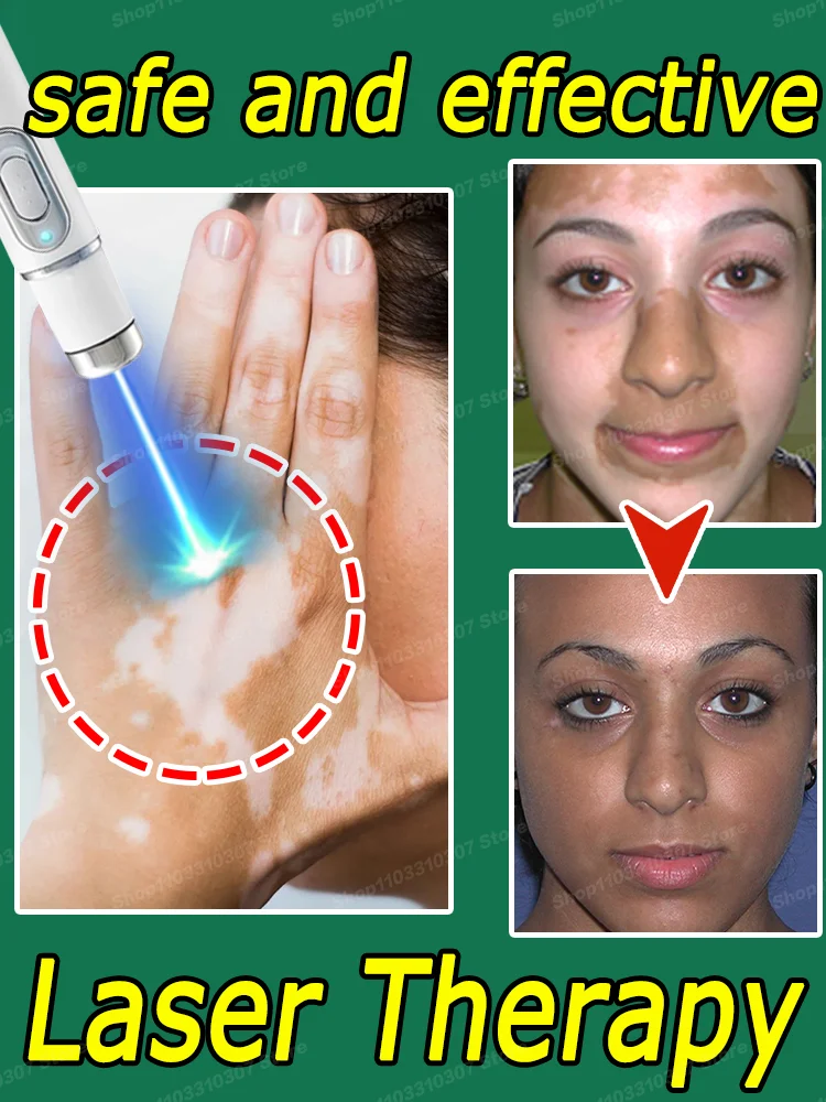 

Vitiligo Quickly ImproveS WhitE Spots