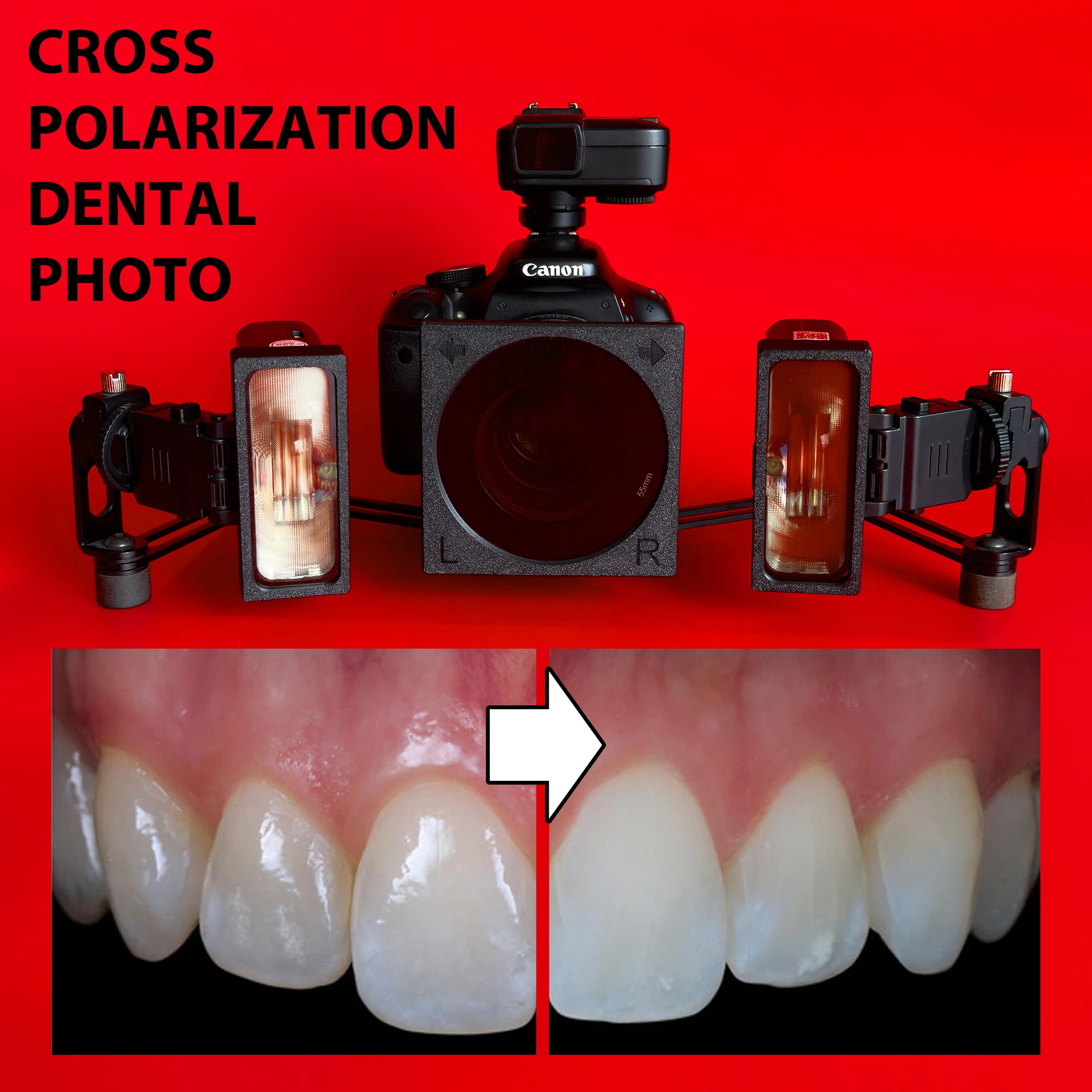 

Cross Polarization Set For Dental Oral Photography - Godox MF12 Camera Flash Polarizer Kit For Dentist. No Reflection, Polar Eye