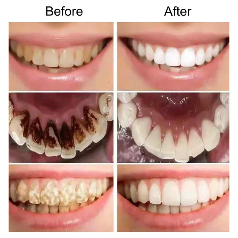 Natural Plant Extract To Repair Tooth Decay Whiten Teeth Remove Tooth Decay Cleaning Stain Remove Cigarette Stains Reduce Yellow