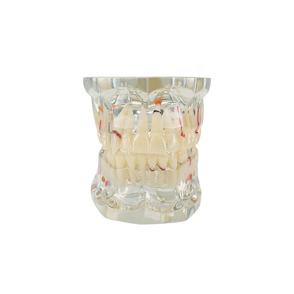 Dental Disease Typodont Small Dental Implant Pathological Teeth Teaching Model For Dental Students Dentist Studying Education