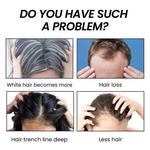 Imagen 2 del producto Suero de crecimiento rápido para el cabello, tratamiento para adelgazar el cabello, antipérdida de cabello, previene la calvicie, cura del cuero cabelludo, nutre las raíces fuertes, aceite de esencia