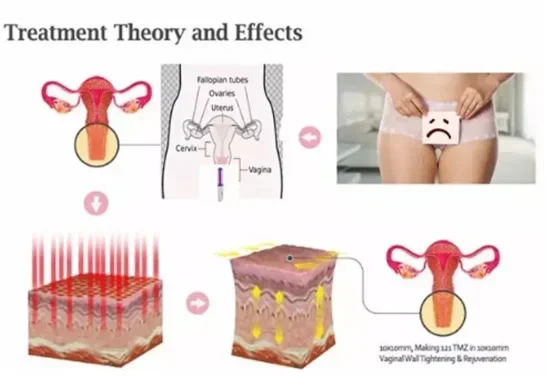 New Invention Low Level Cold Laser Therapy For Vaginal Inflammation And Cervical Erosion