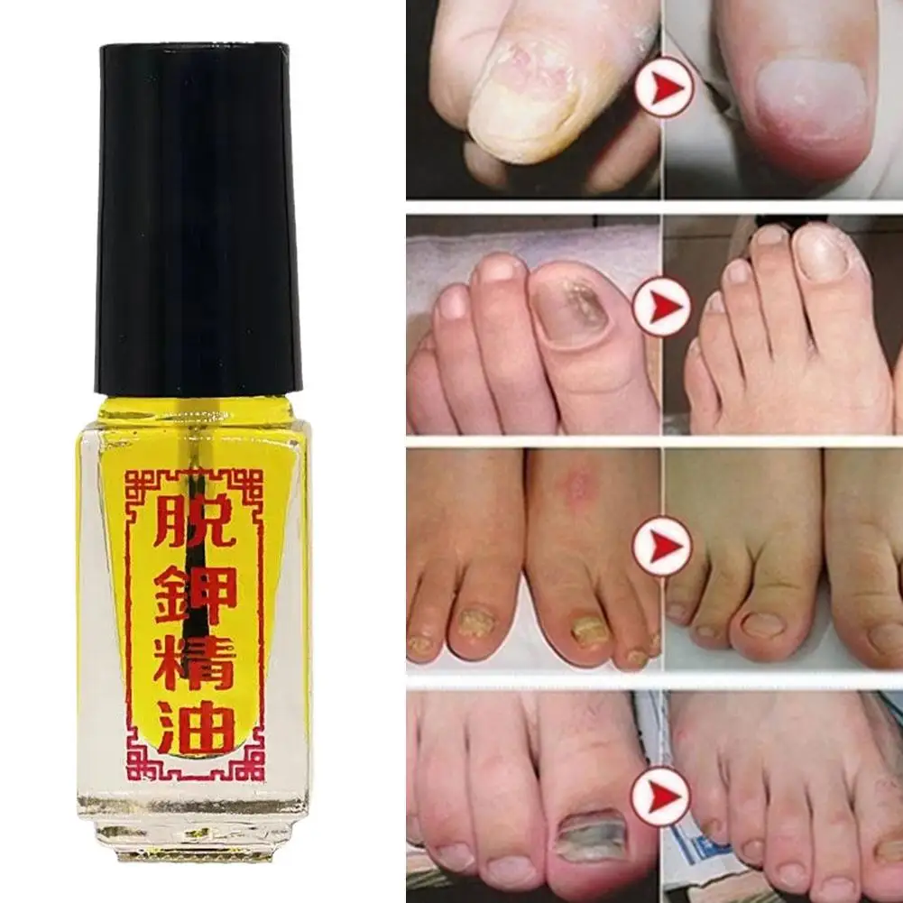 Fungus Removal Liquid Fungal Nail Treatment Foot Care Toe Nails Repair Care Essence Natural Plant Foot Nail Anti Infection Oil
