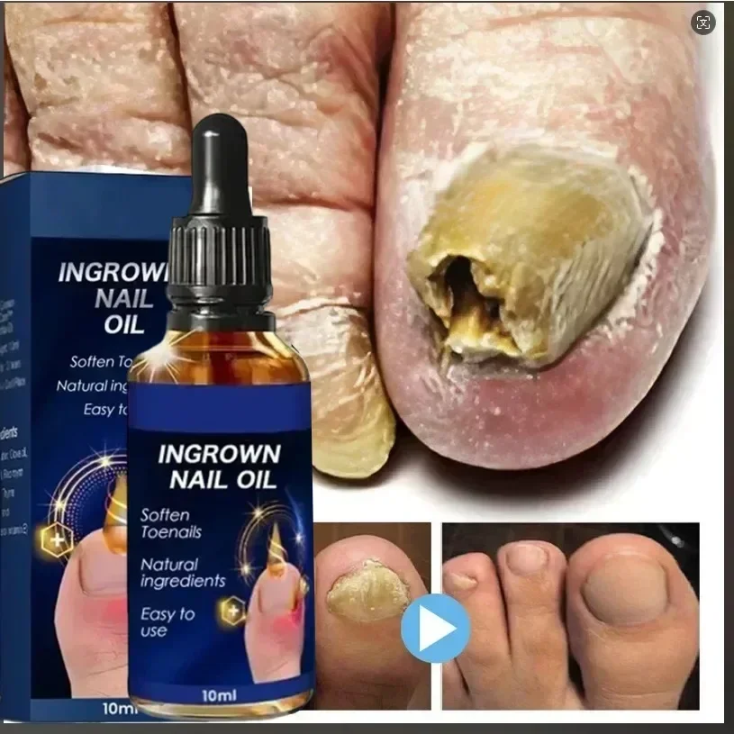 

Fungal Nail Removal 10ML Fungal Nail Treatment Oil Foot Repair Essence Toe Nail Fungus Removal Gel Anti Infection Cream