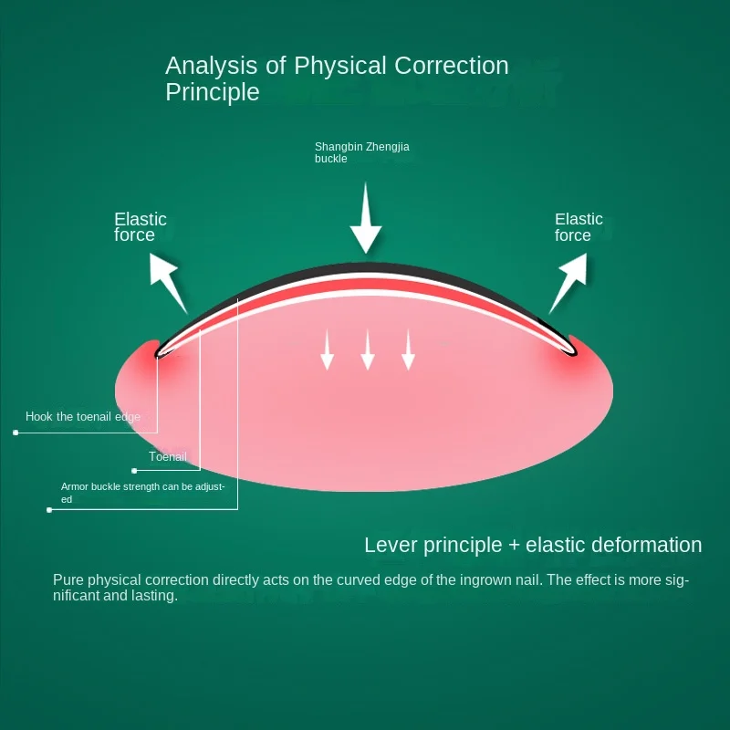Narzędzia do korekcji wrastających paznokci Pedicure odzyskaj osadzanie leczenia paznokci u stóp profesjonalna korekta wrastających paznokci narzędzie do pielęgnacji stóp