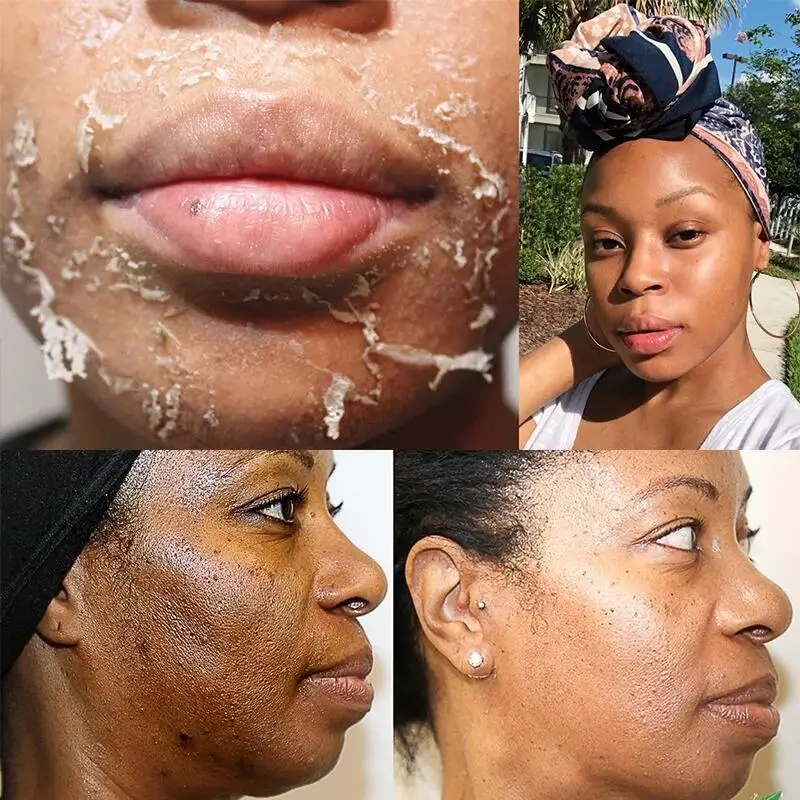 Gelbes Peeling-Lotionöl, 100 % organisches Bleichen, Peeling für dunkle Haut, Aufhellung, nährende Hyaluronsäure, feuchtigkeitsspendende