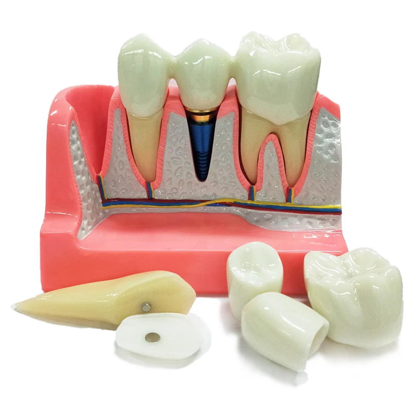 4 Times Dental Implant Teeth model Crown Bridge Demonstration Removable Model Porcelain Teeth Dental Teaching Model for Dentist