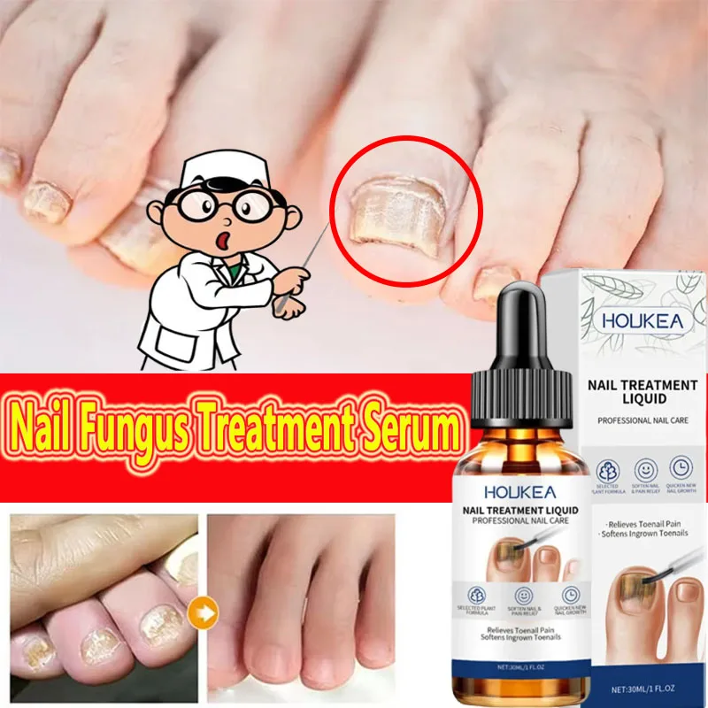 Esencja na grzybicę paznokci usuwająca infekcje grzybieniowe paznokci, regenerująca zniszczone paznokcie u stóp, produkt do pielęgnacji paznokci.