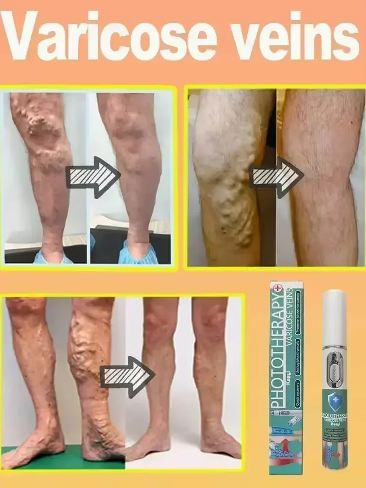 Laser vein | painless treatment of varicose veins | Relieve spider leg pain