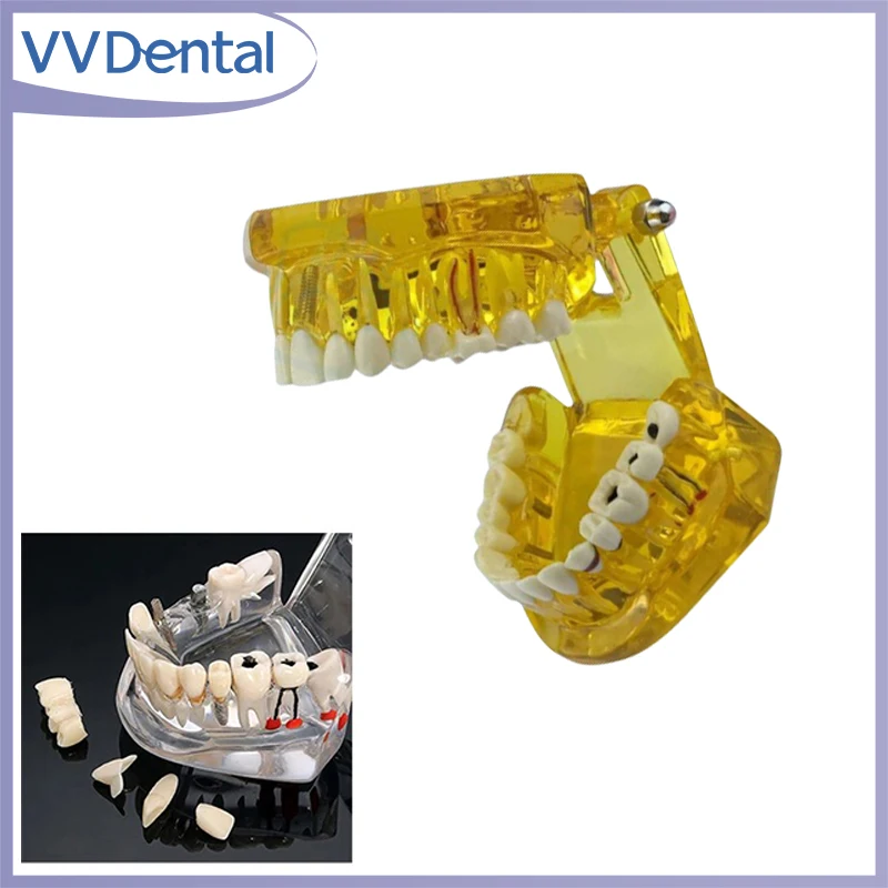 

Модель зубов для лечения зубных заболеваний с реставрационным зубом моста для медицинской науки, обучающая модель для обучения зубных заболеваний