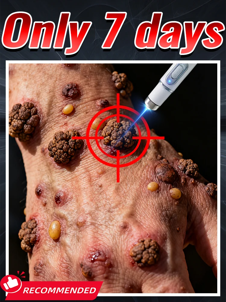 

ᴸᵃˢᵉʳ ᵖᵉⁿ ᵃᶜᶜᵘʳᵃᵗᵉˡʸ ʳᵉᵐᵒᵛᵉˢ warts without scarring or recurrence