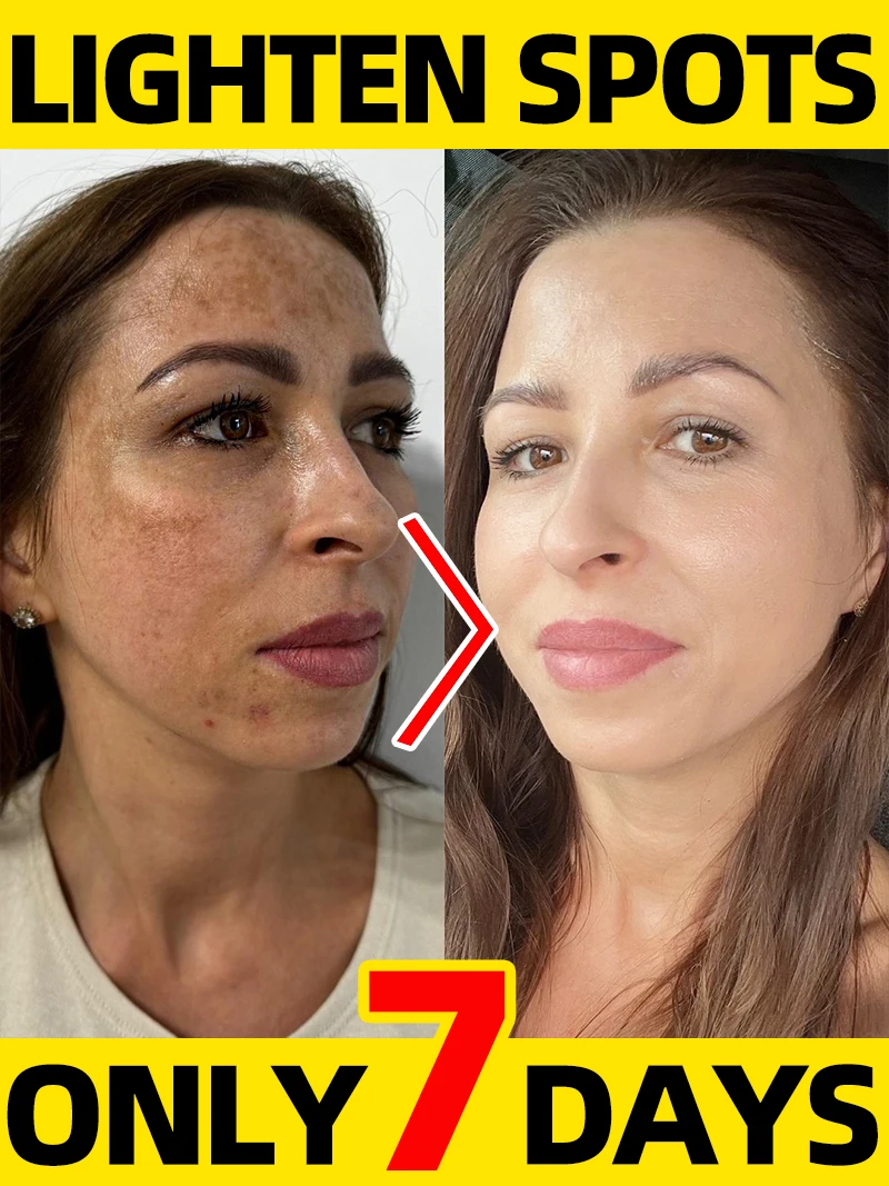 

Age Dark Sun Spot Freckles Chloasma Clear