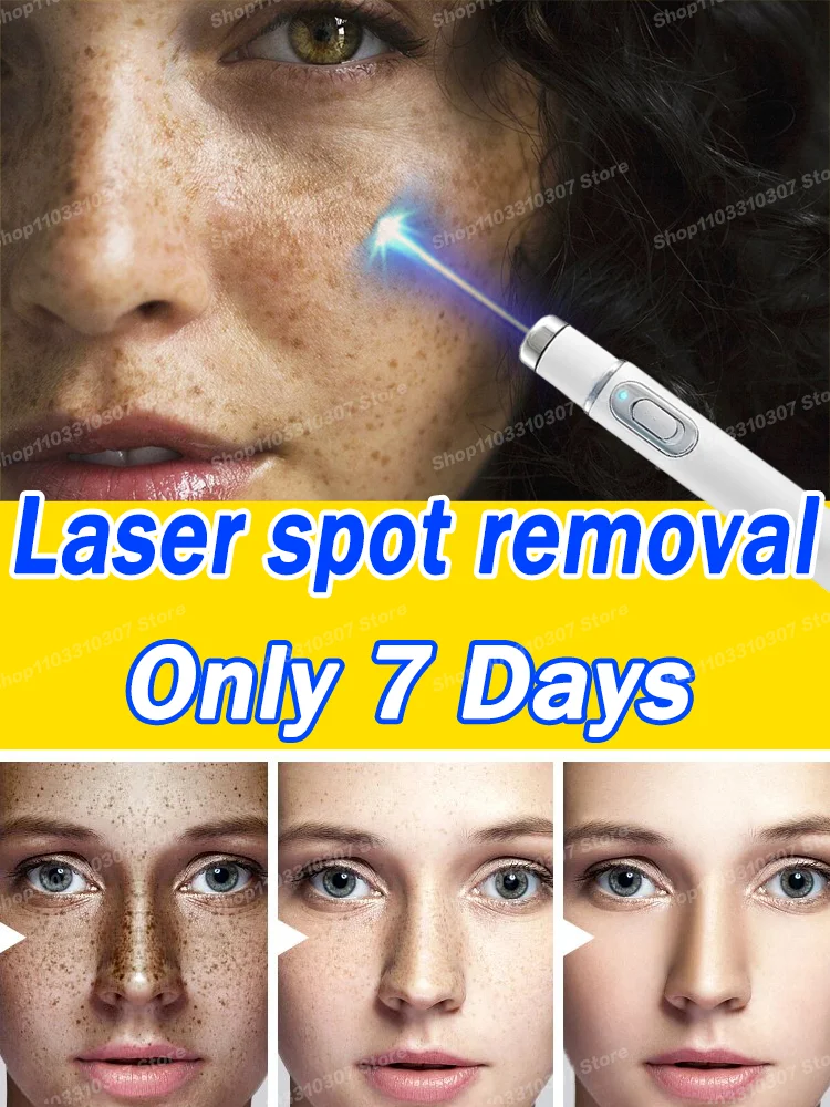 

Nano laser Facial spots are gone