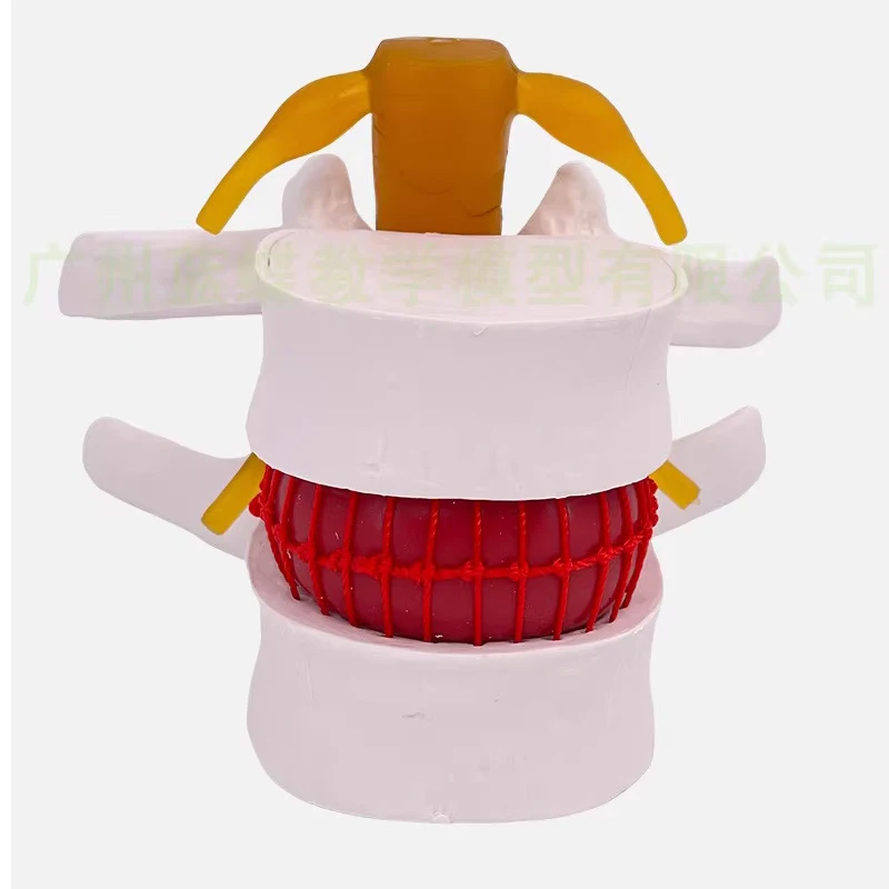 Demonstration model of medical human lumbar intervertebral disc compression Demonstration of pathological lateral compression of