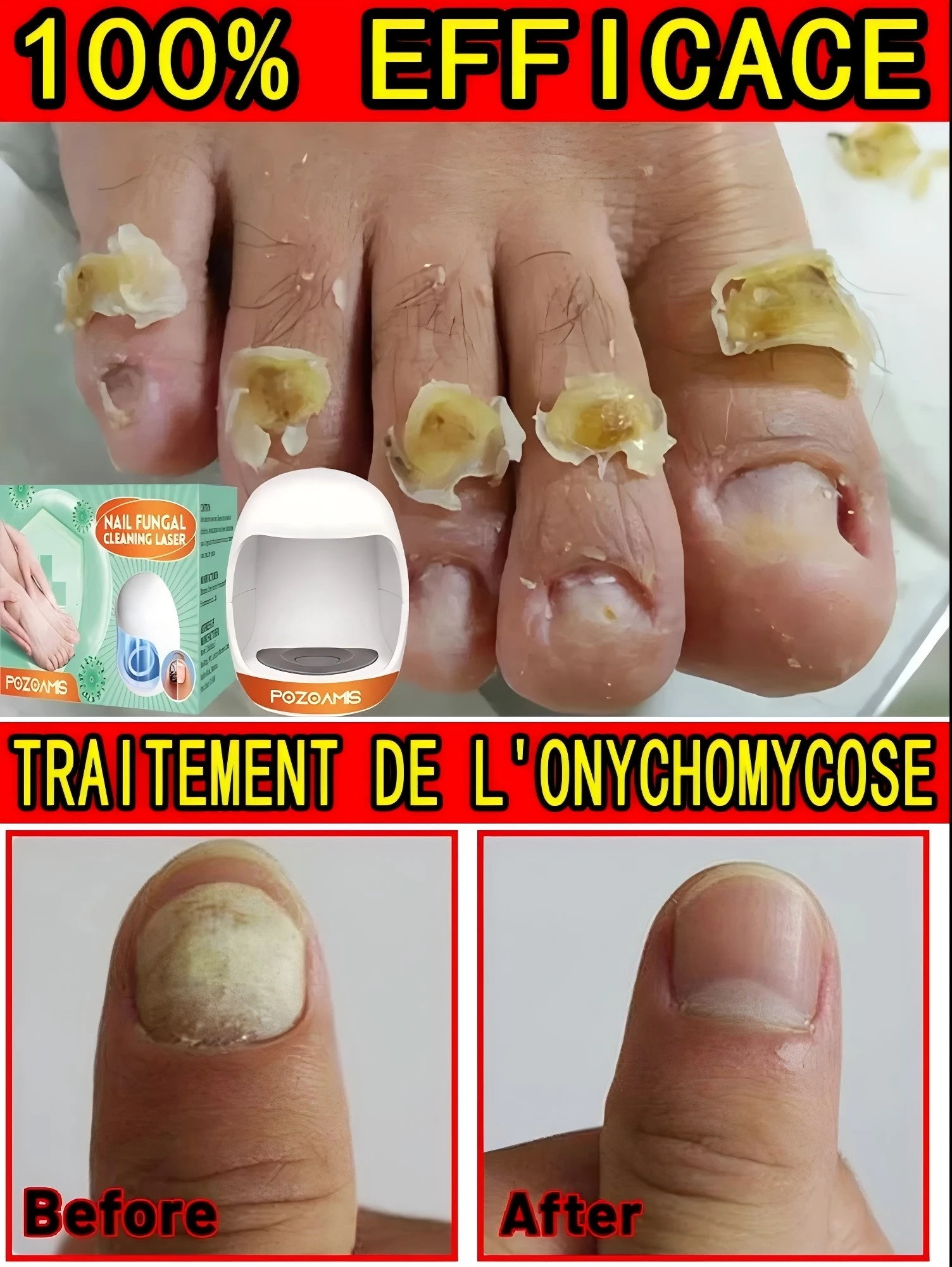 Inychomycosis laser equipment to repair toenail fumgus onychomycosis essence to repair toenails nail removal onychonycosis treat