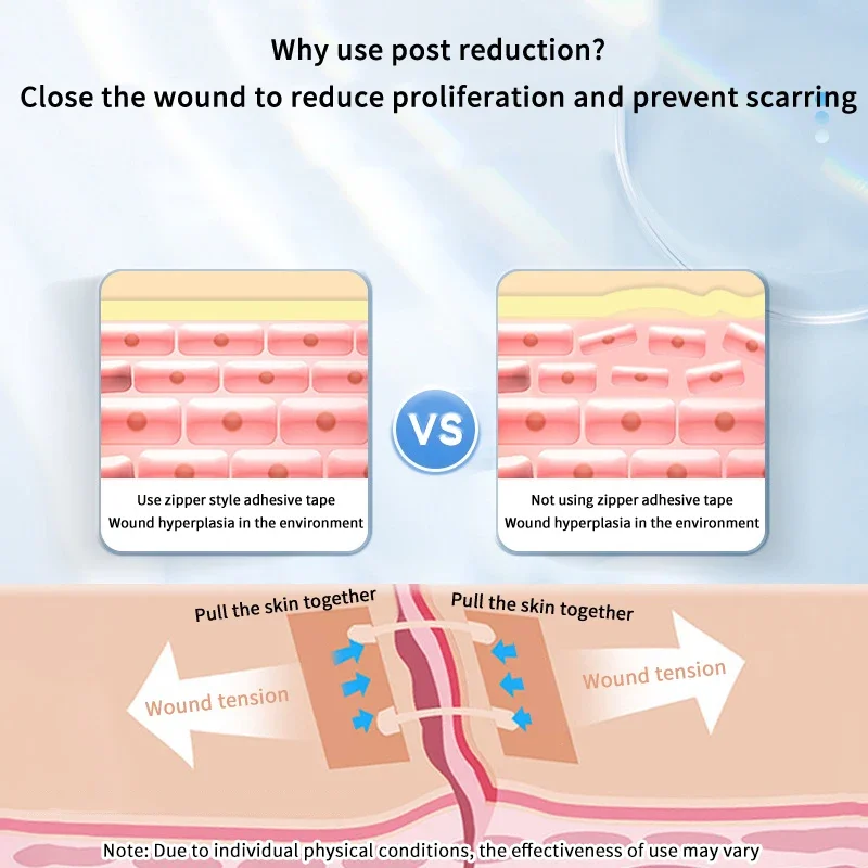 แผ่นปิดแผลแบบรัดรูป 2 ชิ้น/กล่อง พร้อมสายรัดยืดหยุ่น ปิดแผลเร็ว ห้ามเลือด ดูแลผิว ฆ่าเชื้อโรค แผ่นปิดแผลพกพาสำหรับกิจกรรมกลางแจ้ง