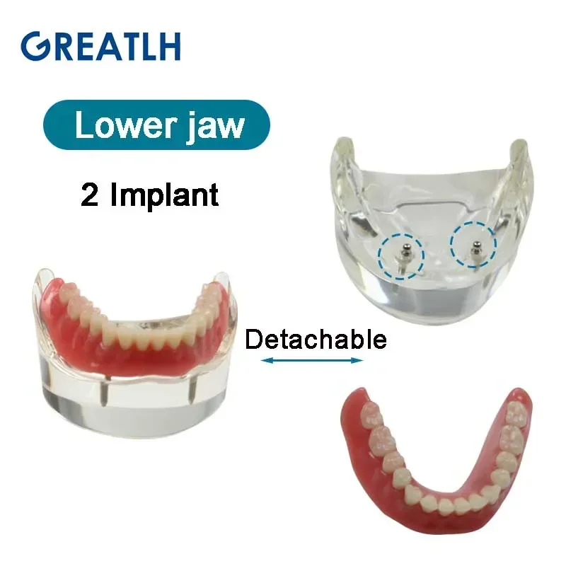 Dental Teeth Model with Implant Overdenture Inferior Demo Mandibular Model Dentist Student Learning Model