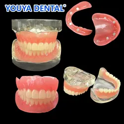 Dental Implant Teeth Overdenture Model Removable Interior Mandibular Demo Denture Model 2/4 Implants Restoration For Studying