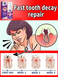 decay Tooth Repair Repairing Cavities Protect Anti caries