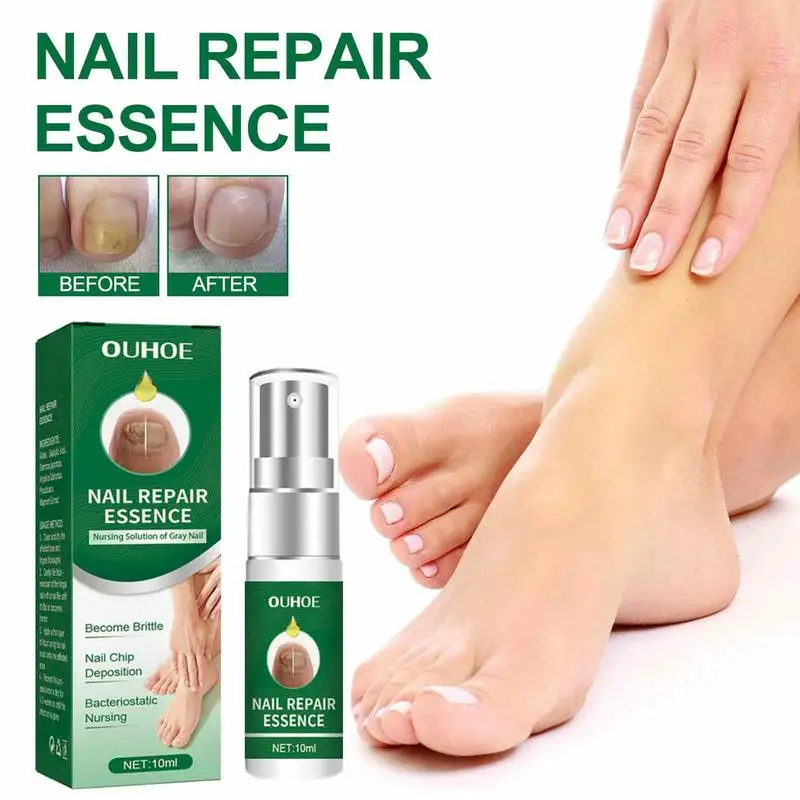 Essência do reparo do prego para o cuidado do toenail, solução para reparar o molde danificado, quebrado rachado, soro descolorido das unhas, essência natural, correção