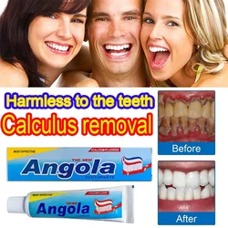 Tartar Removal Dental Calculus Teeth Whitening