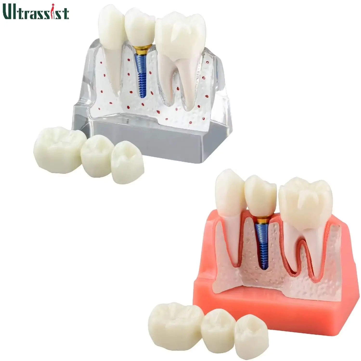 

Ultrassist Dental Implant Crown & Bridge Model 4 Times Dental Implant Abutment Tooth Root Structure for Patient Educate Display